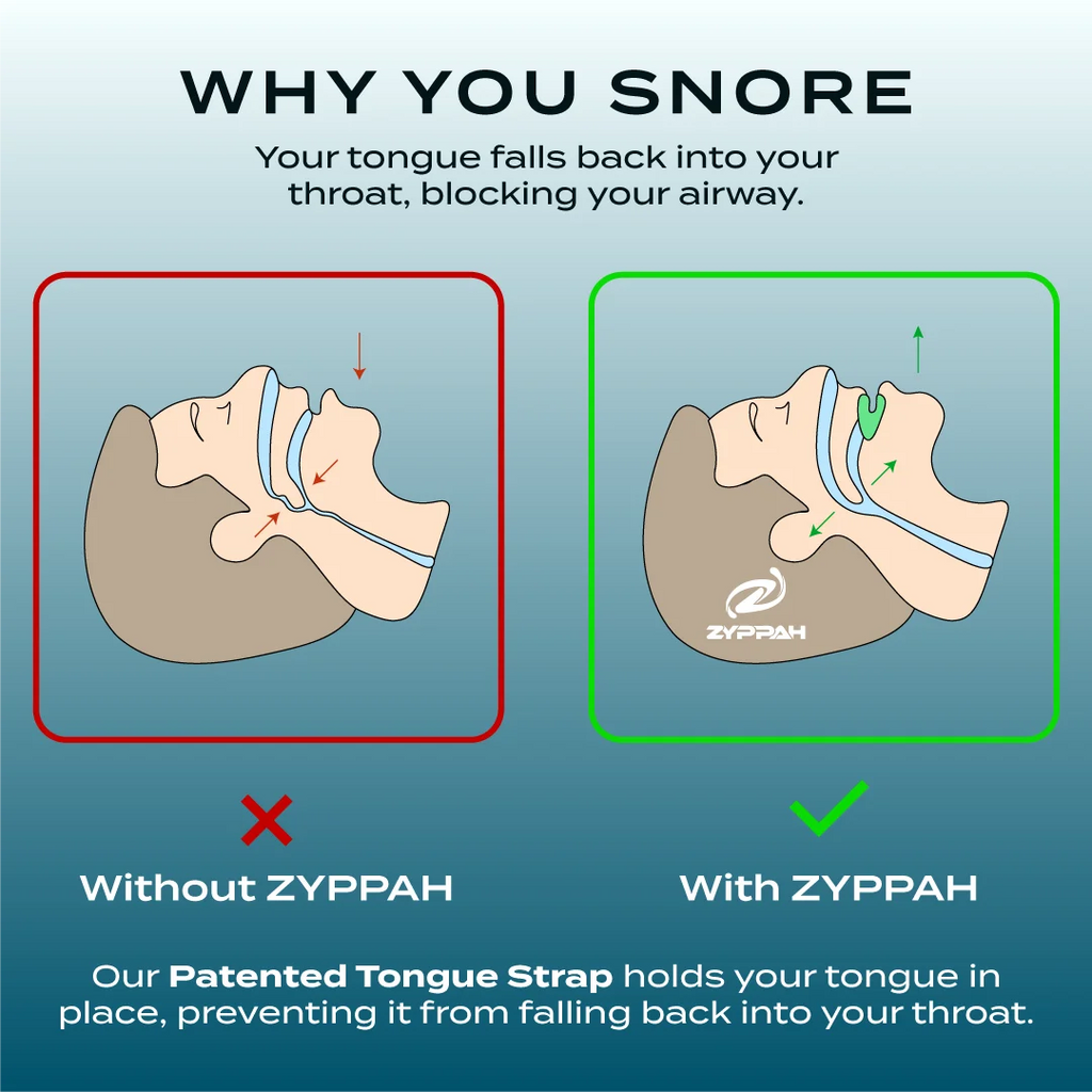 ZYPPAH Anti Snoring Hybrid Oral Appliance Mouthguard B2363