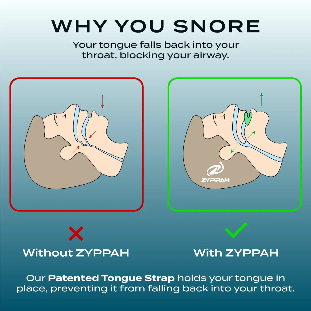 ZYPPAH Anti Snoring Hybrid Oral Appliance Mouthguard B2363